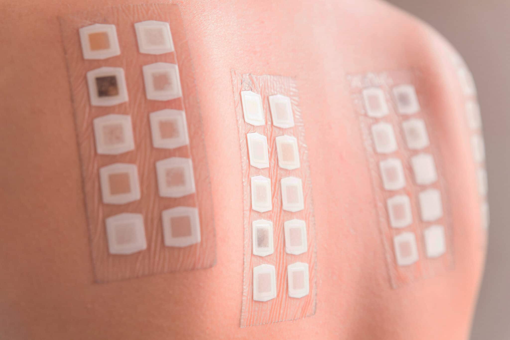 Contact Dermatitis Patch Testing Techniques Hope Dermatology 